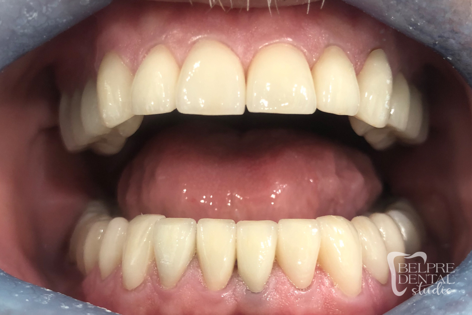 Before & After Smile Gallery ⋆ Belpre Dental Studio®